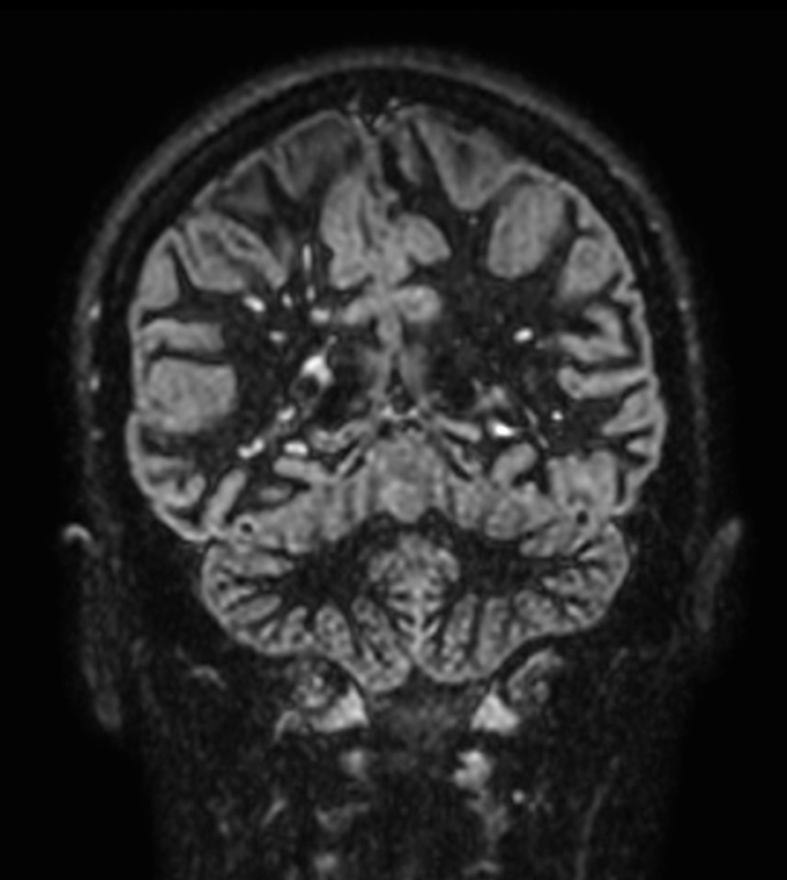 3D Double IR (Reformat) <b>Compressed SENSE</b>