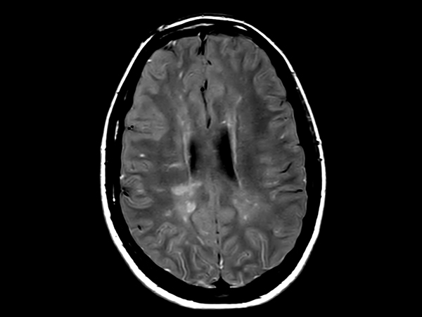 PDw TSE <b>Compressed SENSE</b>