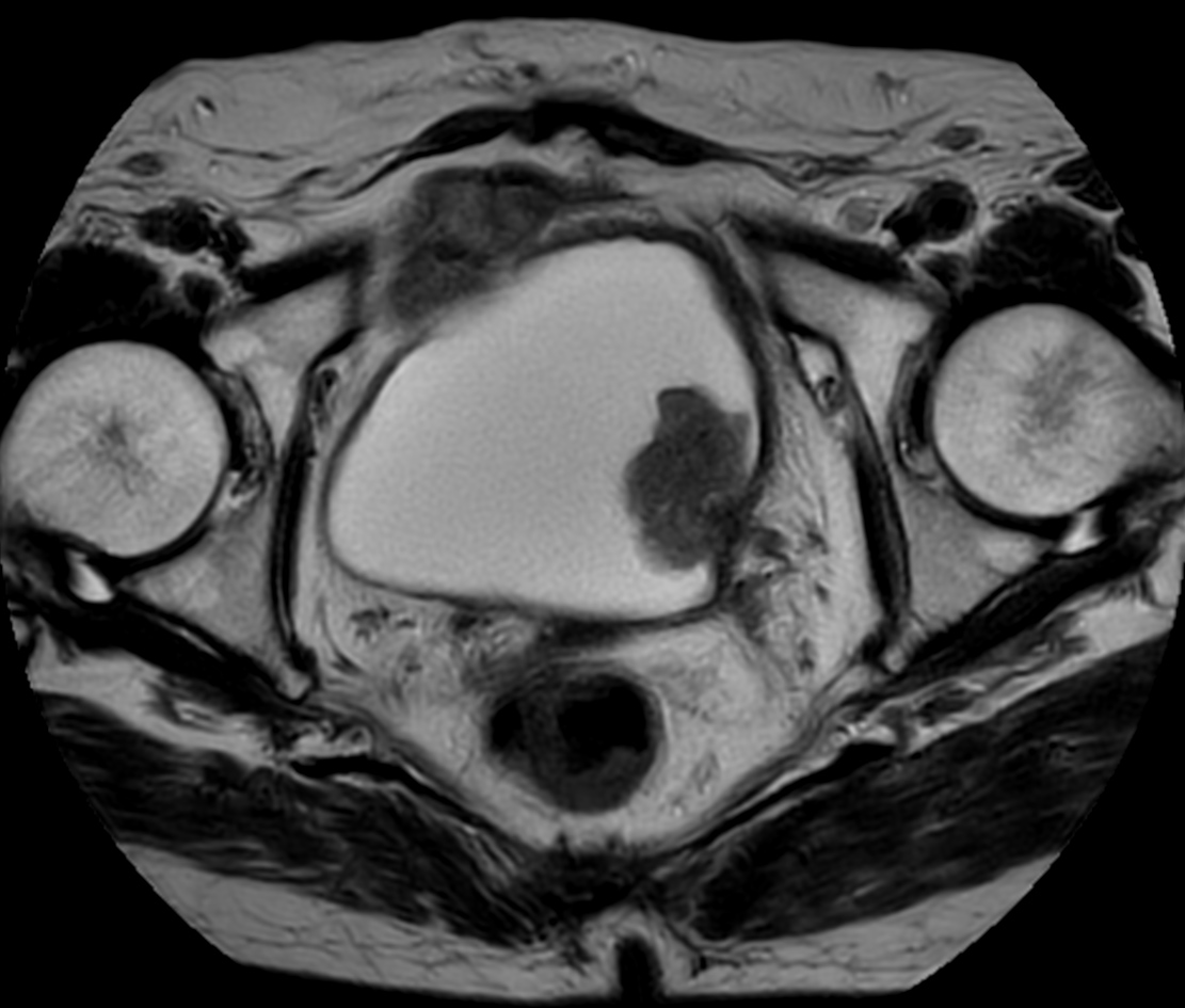 T2w TSE MultiVane XD