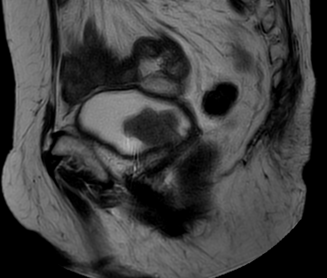 T2w TSE MultiVane XD