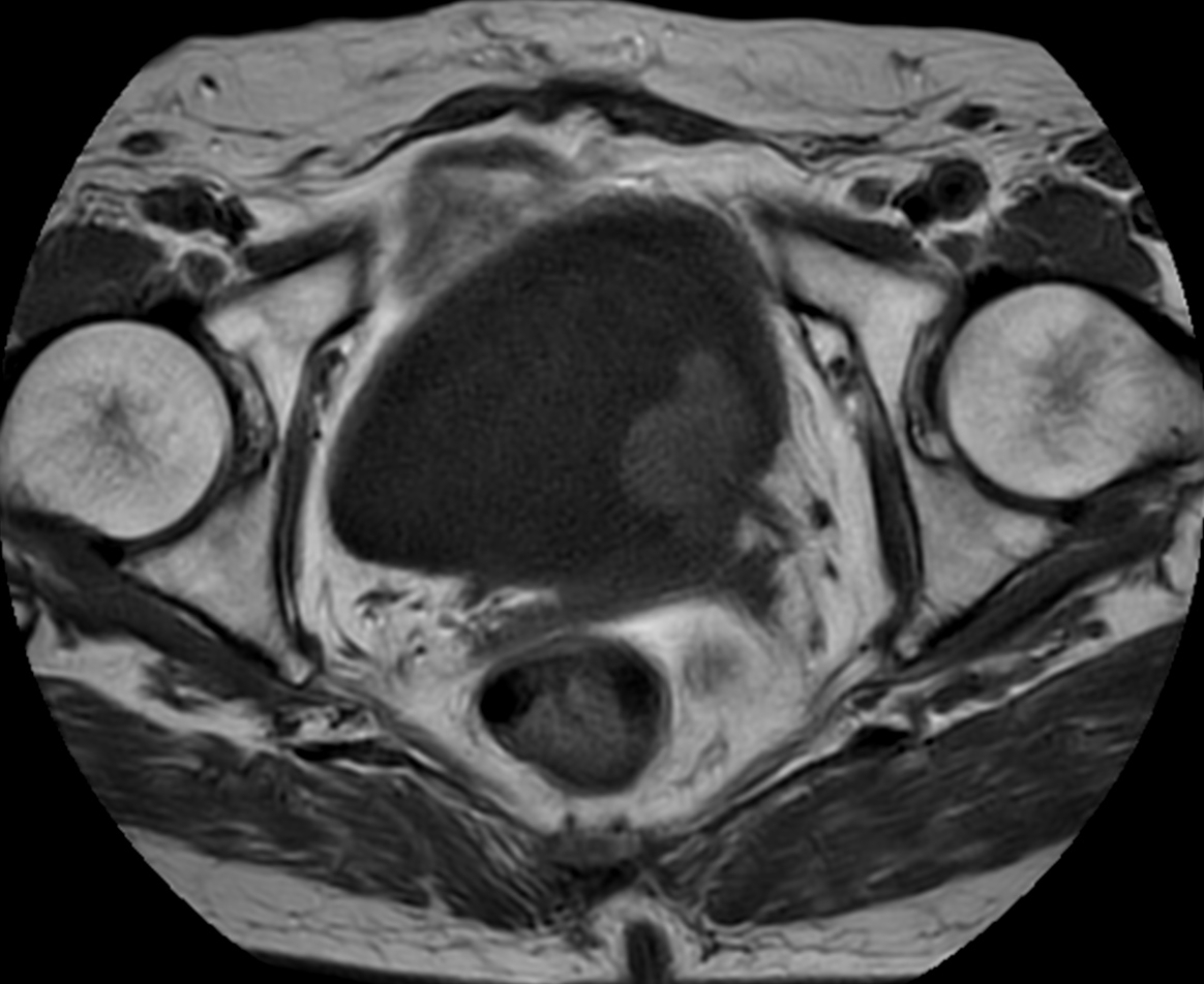 T1w TSE MultiVane XD