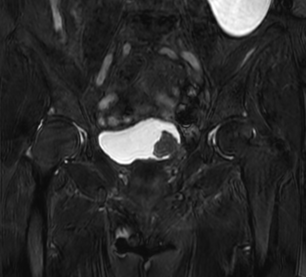 3D bTFE <b>Compressed SENSE</b>