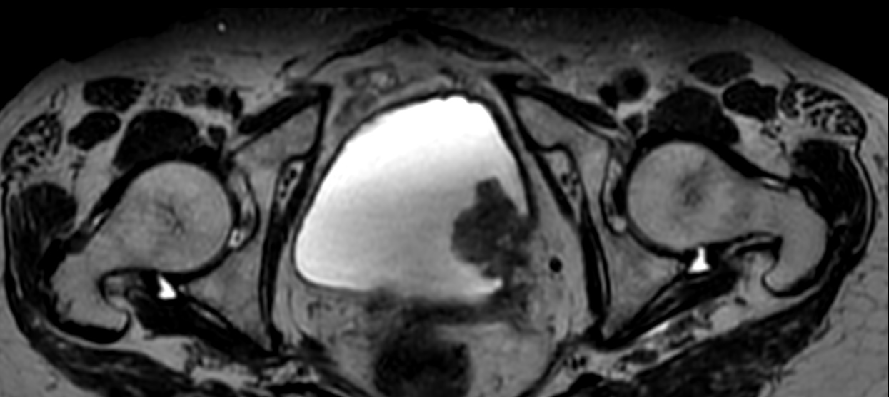 3D T2w TSE PelvisVIEW (reformat) <b>Compressed SENSE</b>