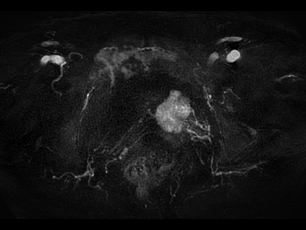 4D FreeBreathing (MIP)