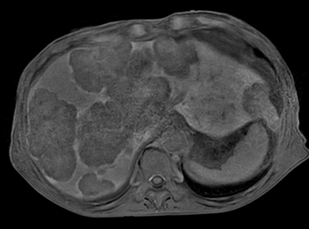 3D eTHRIVE with gado (15 minutes delay) <b>Compressed SENSE</b>