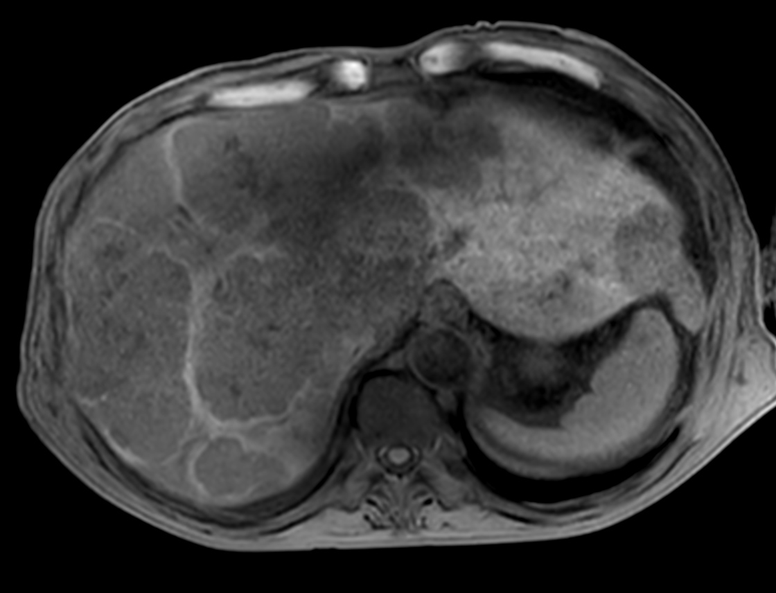 T1w mDIXON XD FFE <b>Compressed SENSE</b>