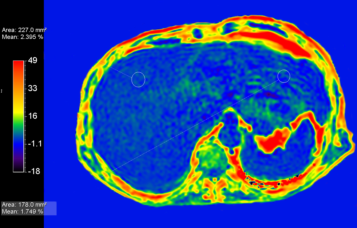 mDIXON Quant <b>Compressed SENSE</b>