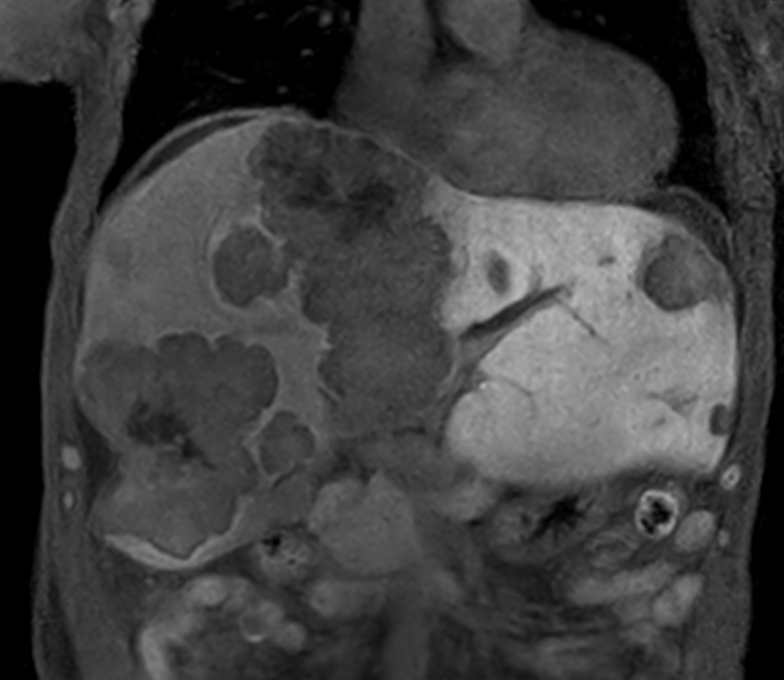 T1w mDIXON XD FFE with gado <b>Compressed SENSE</b>