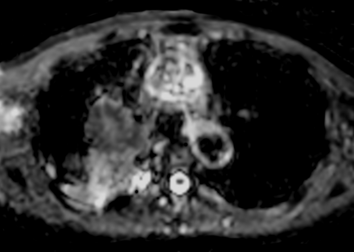 DWI TSE XD b1000 (ADC) <b>Compressed SENSE</b>