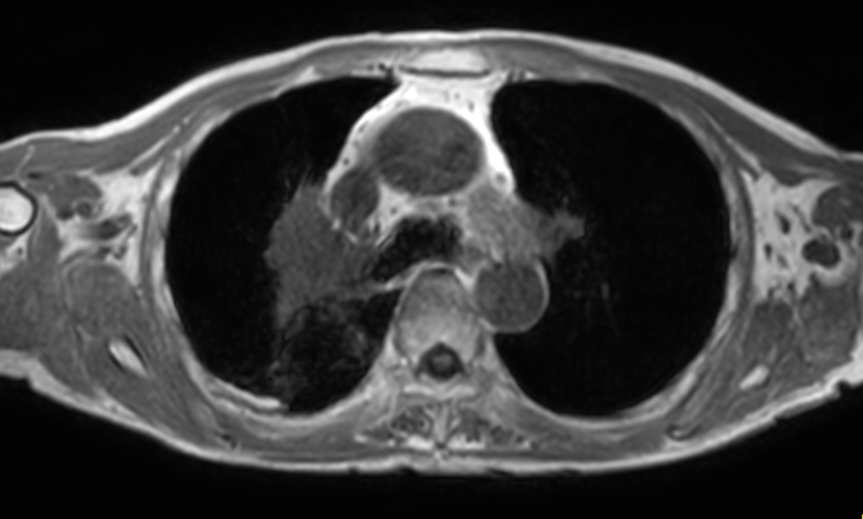 T1w mDIXON XD FFE (In Phase) <b>Compressed SENSE</b>