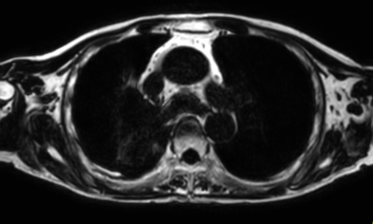 T1w mDIXON XD FFE (Fat only) <b>Compressed SENSE</b>
