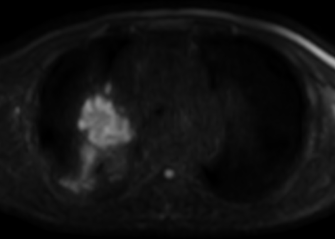 DWI TSE XD b1000 <b>Compressed SENSE</b>