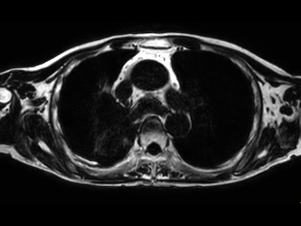 T1w mDIXON XD FFE (Fat only) <b>Compressed SENSE</b>