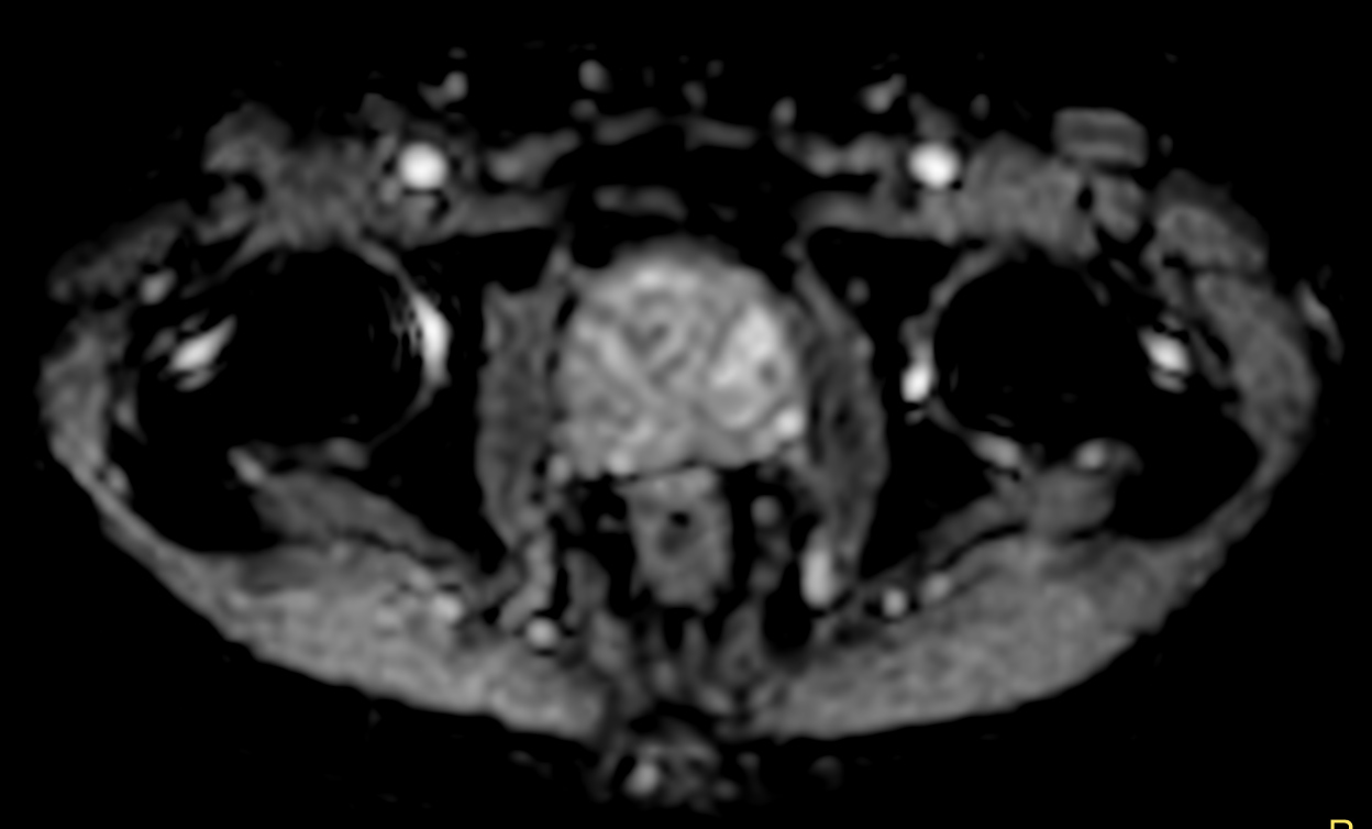 DWI b2000 large FOV (ADC)