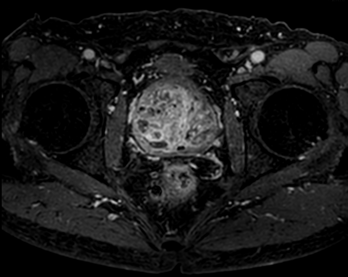 3D eTHRIVE with gado <b>Compressed SENSE</b>