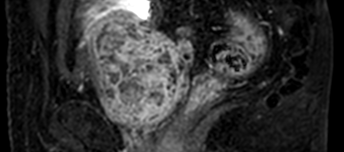 3D eTHRIVE with gado (reformat) <b>Compressed SENSE</b>