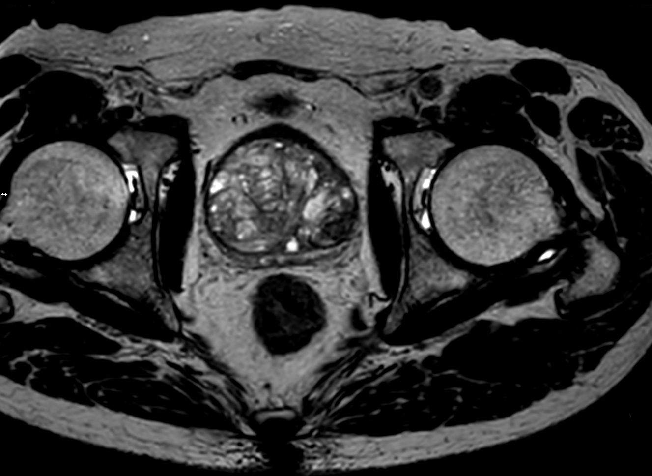 3D T2w TSE PelvisVIEW <b>Compressed SENSE</b>