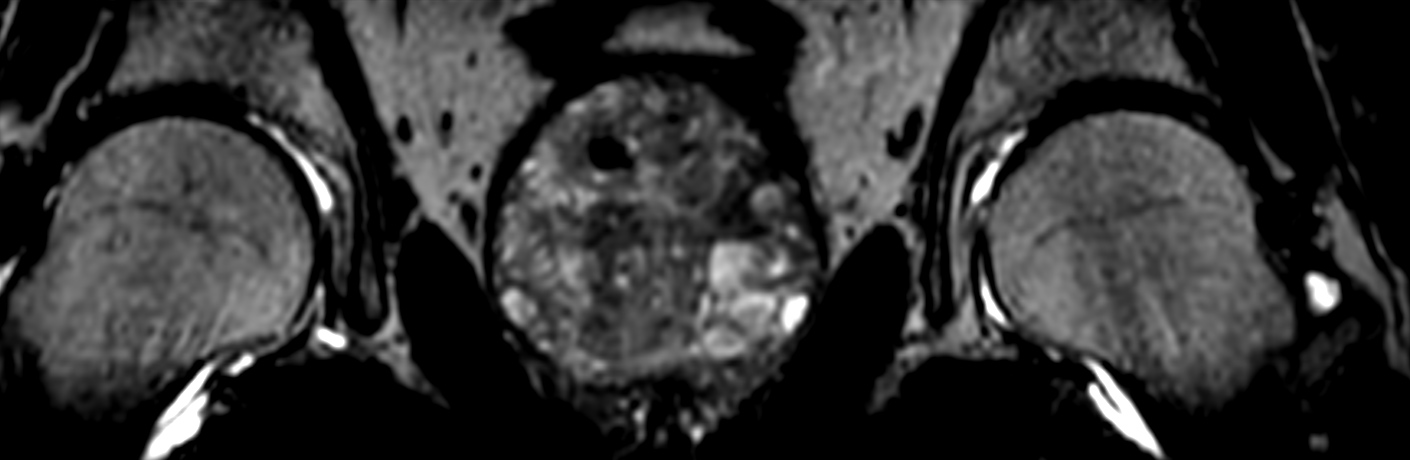 3D T2w TSE PelvisVIEW (reformat) <b>Compressed SENSE</b>