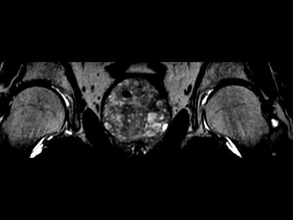 3D T2w TSE PelvisVIEW (reformat) <b>Compressed SENSE</b>