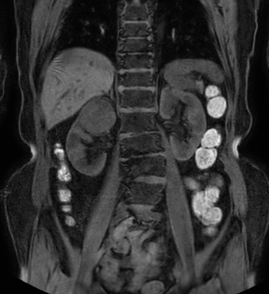 T1w mDIXON XD FFE (Water only)