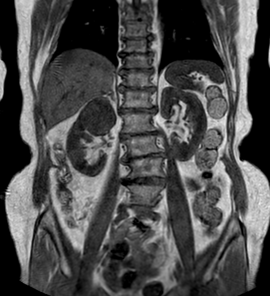 T1w mDIXON XD FFE (In Phase)