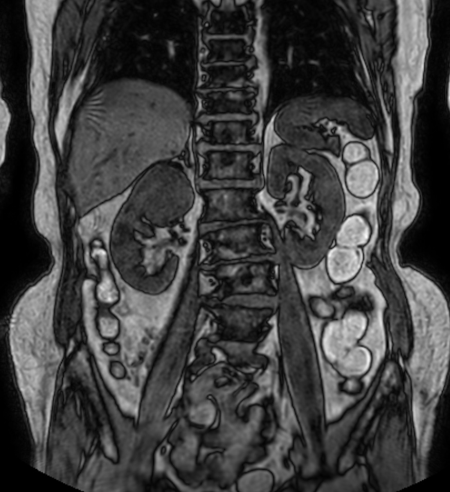 T1w mDIXON XD FFE (Out Phase)