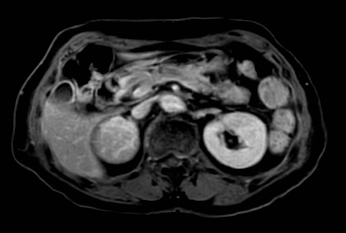 T1w mDIXON XD FFE with gado (Water only)