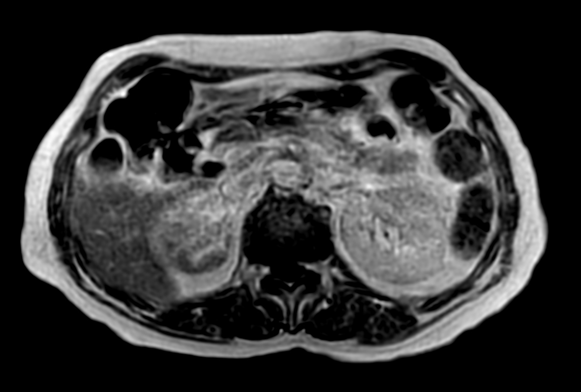 T1w mDIXON XD FFE with gado (In Phase)
