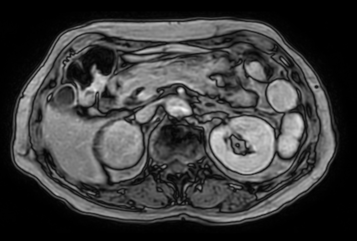T1w mDIXON XD FFE with gado (Out Phase)