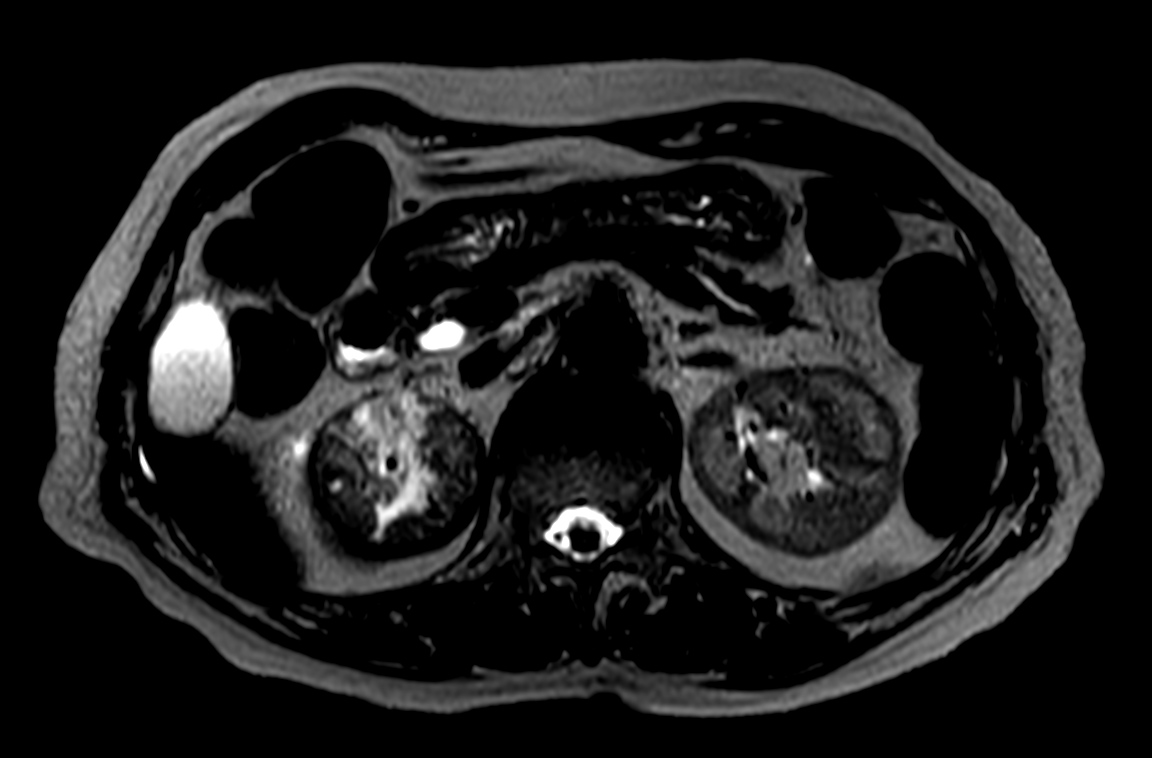 T2w TSE heavy weighted