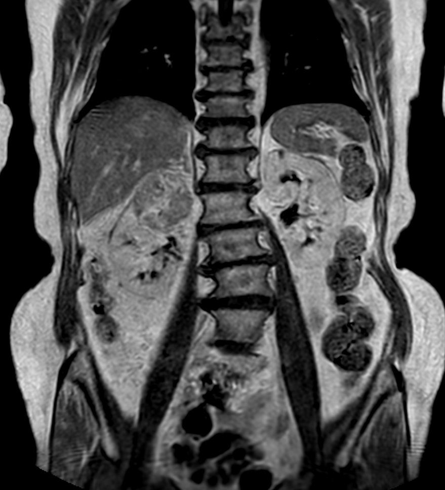 T1w mDIXON XD FFE with gado (In Phase)