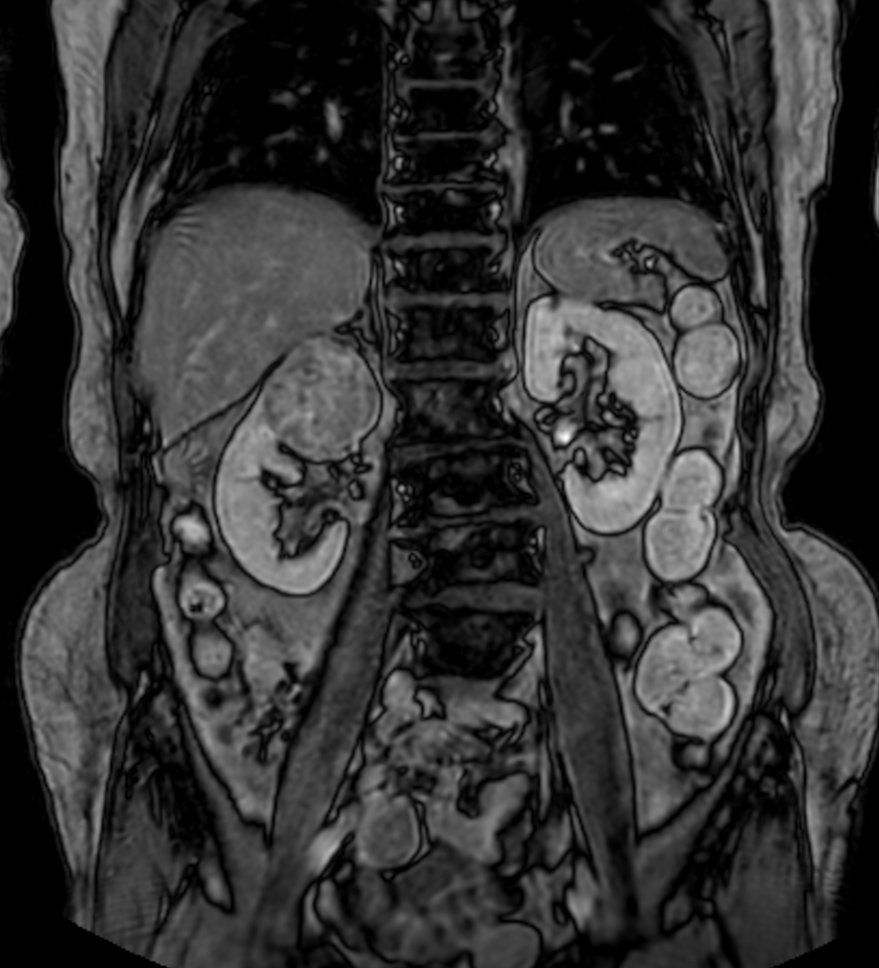 T1w mDIXON XD FFE with gado (Out Phase)