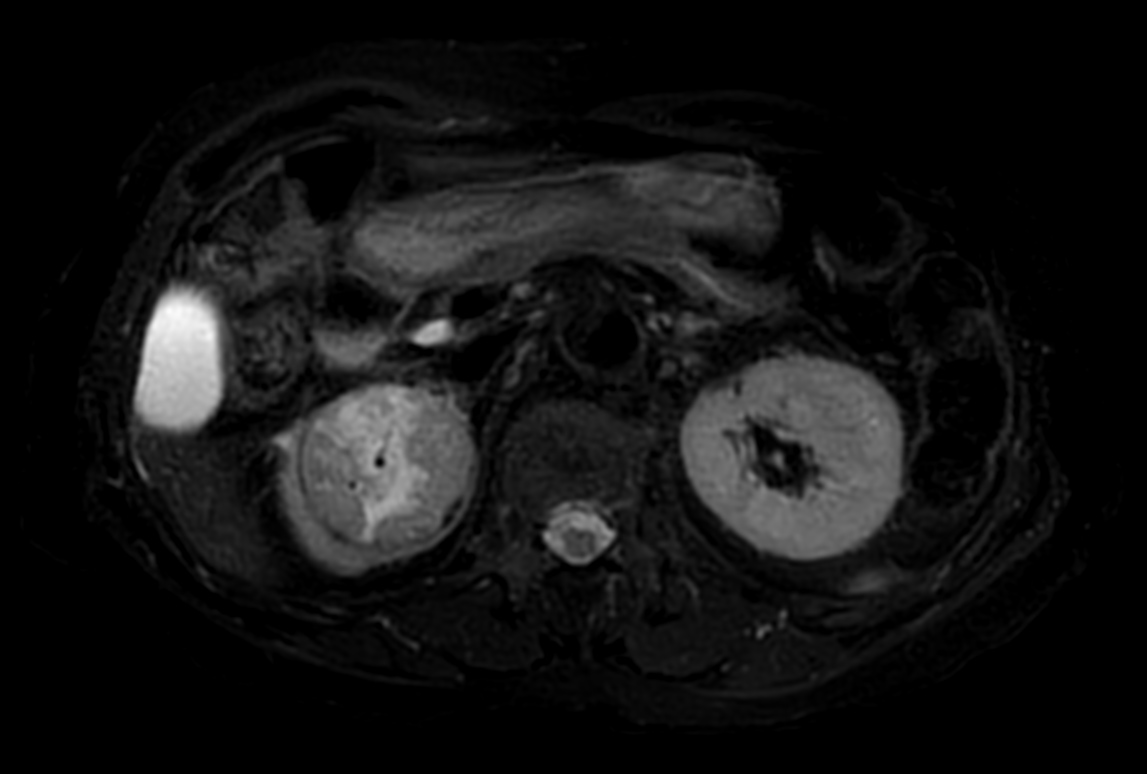 T2w TSE FatSat MultiVane XD