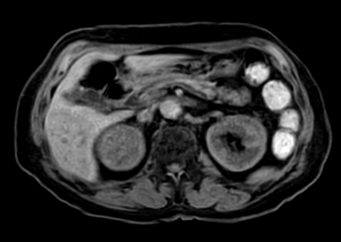 T1w mDIXON XD FFE (Water only)