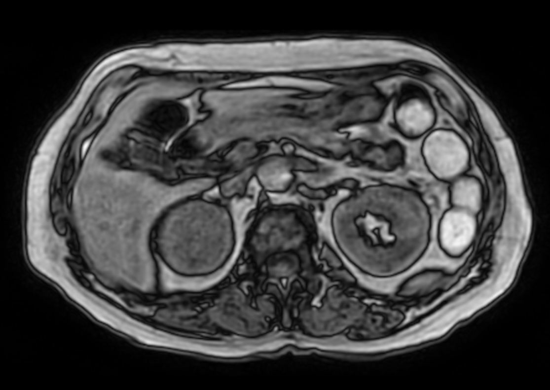T1w mDIXON XD FFE (Out Phase)