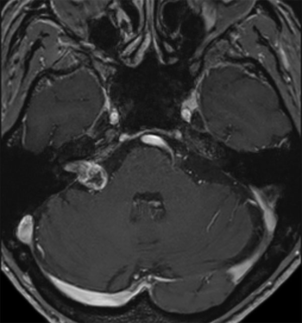 Axial T1w 3D TFE (post-gado)