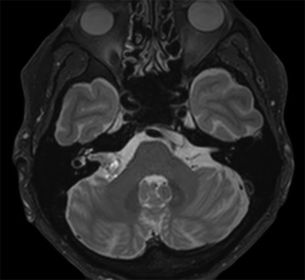 Axial T2w BrainView