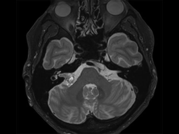 Axial T2w BrainView