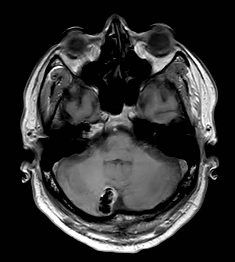 T1w FFE <b>Compressed SENSE</b>