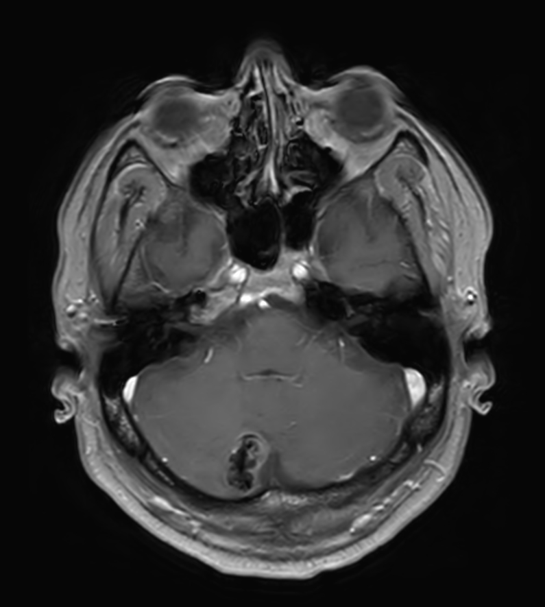 T1w FFE post-gado <b>Compressed SENSE</b>