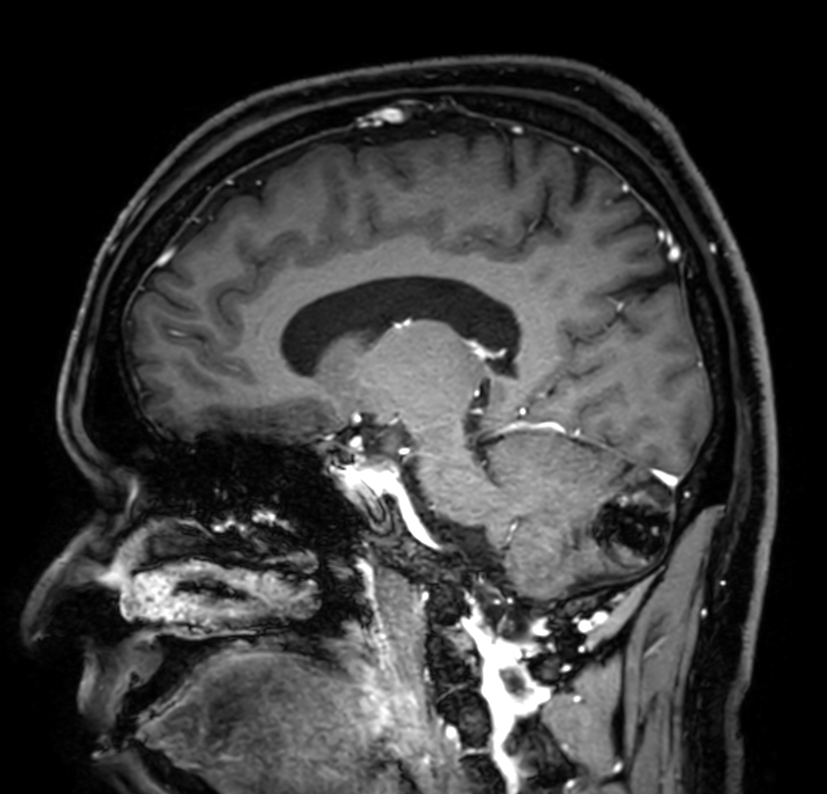 3D T1w FFE FatSat post-gado (reformat) <b>Compressed SENSE</b>