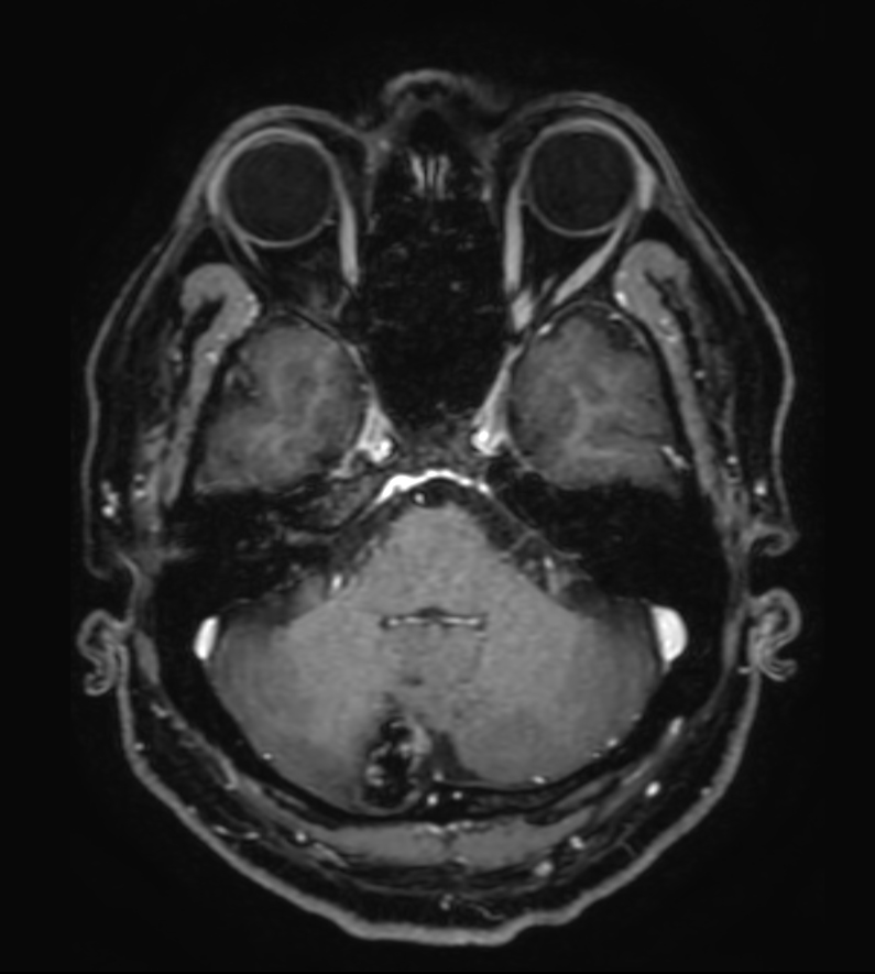 3D T1w FFE FatSat  post-gado (reformat) <b>Compressed SENSE</b>