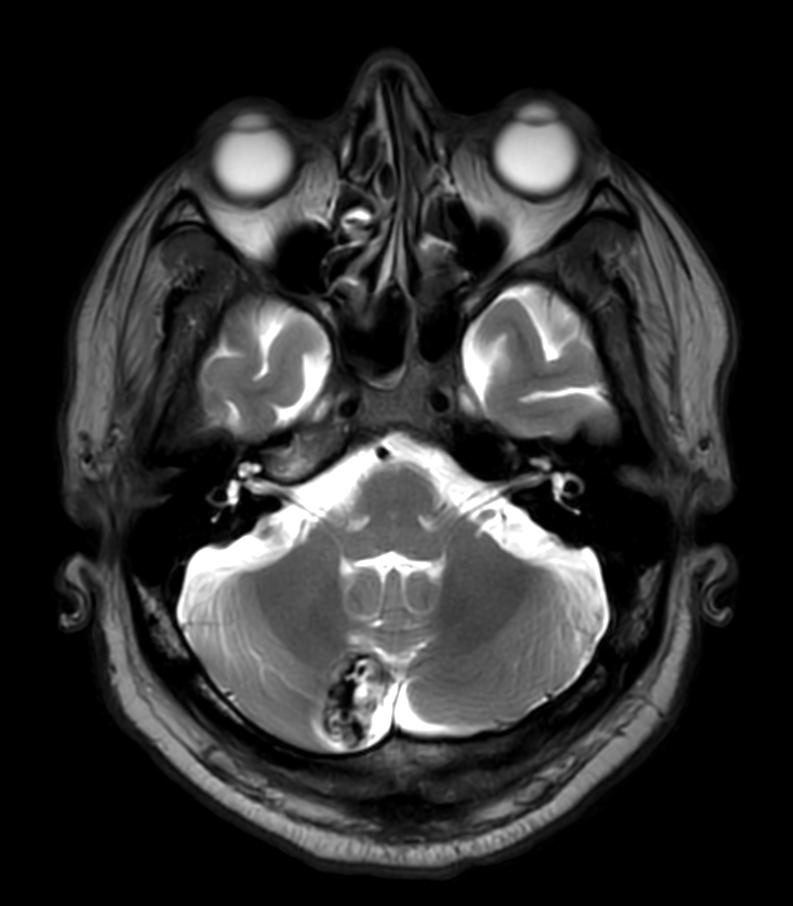 T2w TSE MultiVane XD