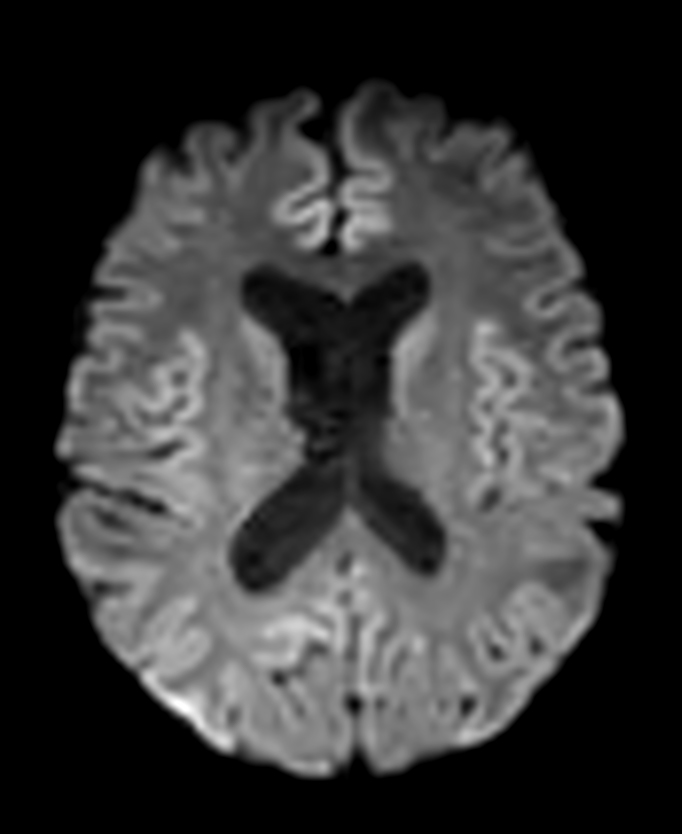 DTI b800 15 directions with EPIC Brain