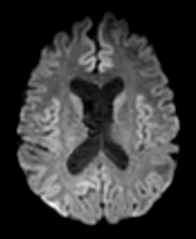 DTI b800 15 directions without EPIC Brain