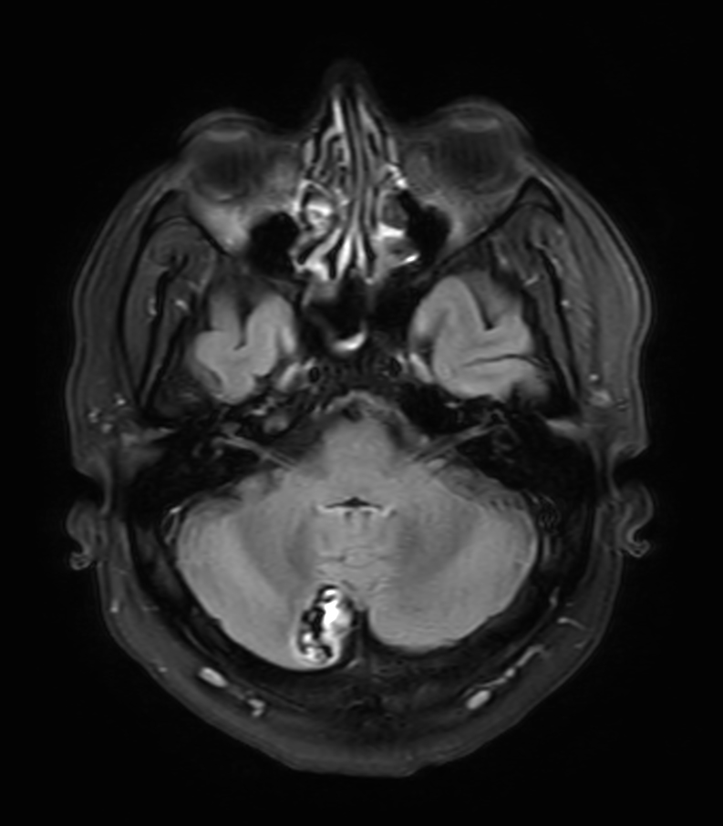 T2w FLAIR <b>Compressed SENSE</b>