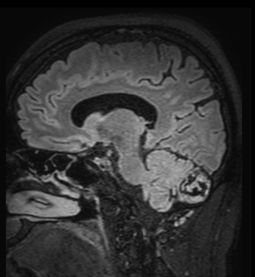 3D T2w FLAIR (reformat) <b>Compressed SENSE</b>