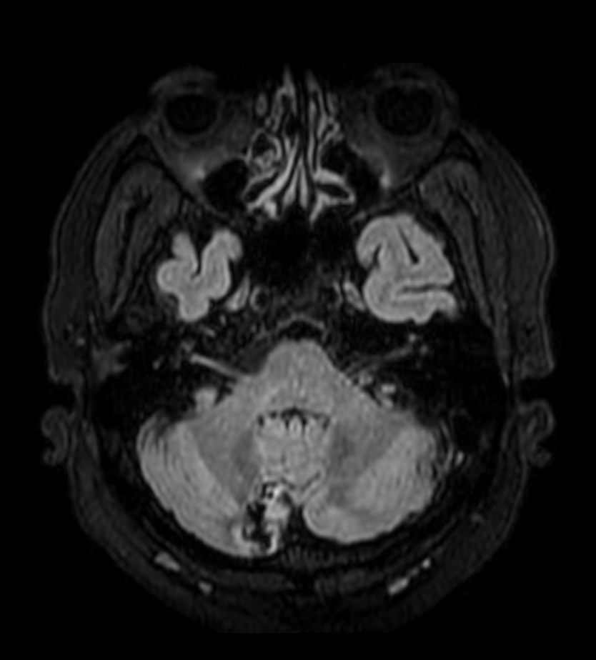 3D T2w FLAIR (reformat) <b>Compressed SENSE</b>