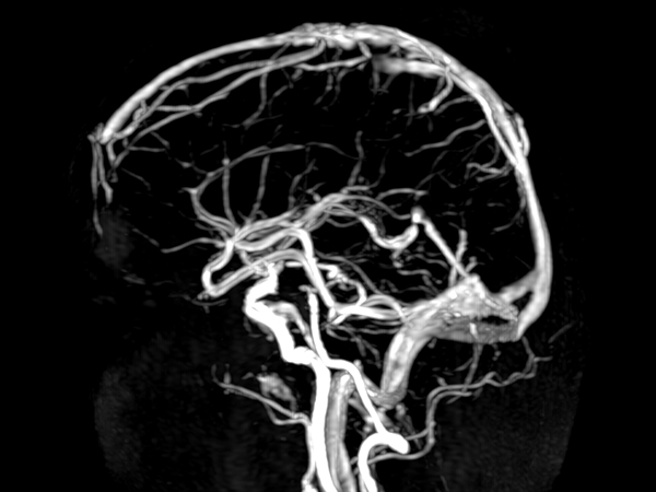 CE MRA (arterial phase) <b>Compressed SENSE</b>