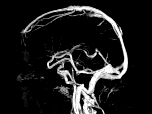 CE MRA (venous phase) <b>Compressed SENSE</b>